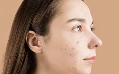 acne scars treatment