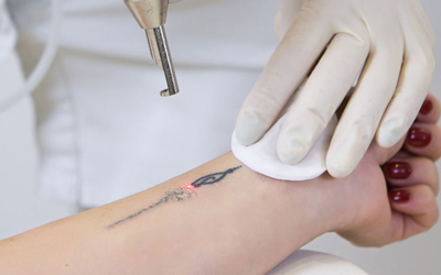 tatto removal